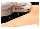 Finding A Qualified Dry Needling Therapy Near You In Edmonton