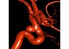 Advanced Neuro Care Through Aneurysm Brain Coiling