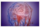 Seeking Advanced Medical Care for Brain Hemorrhage?